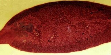 παράσιτο τρεματόδος πώς να αφαιρέσετε από το σώμα